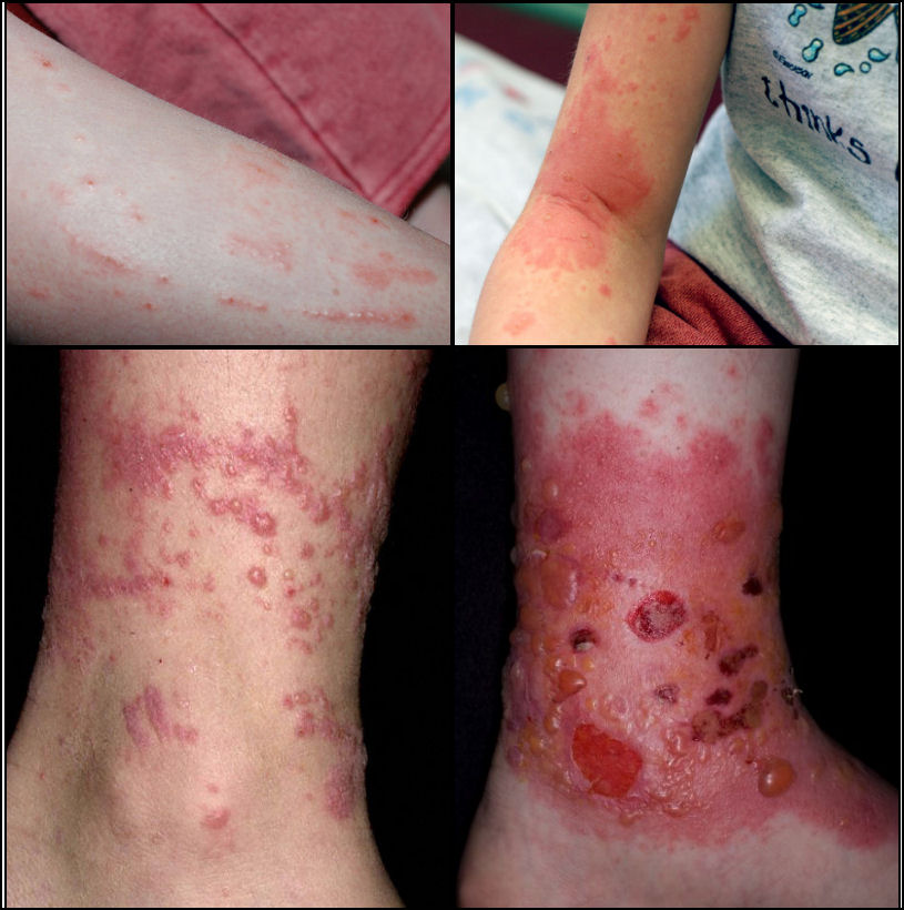 Name:  Poison-Ivy-Oak-Sumac-rash-pictures.jpg
Views: 662
Size:  116.3 KB