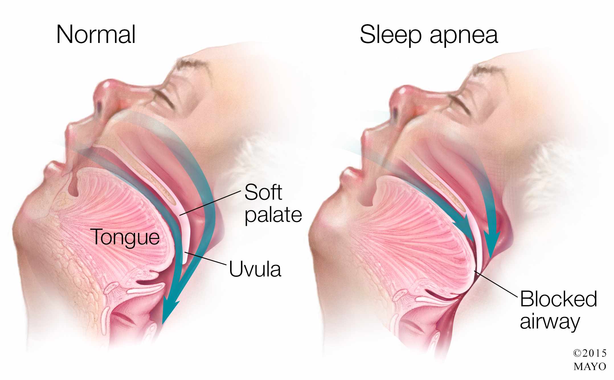 Name:  Medical-illustration-of-sleep-apnea.jpg
Views: 591
Size:  132.8 KB