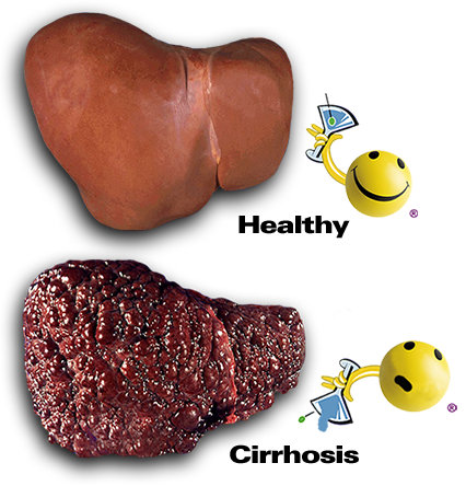 Name:  cirrhosis-of-the-liver-1.jpg
Views: 710
Size:  52.9 KB