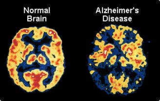 Name:  alzheimers-large.jpg
Views: 514
Size:  53.8 KB