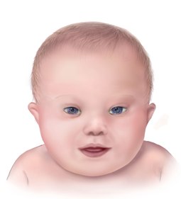 Name:  Down_syndrome.jpg
Views: 833
Size:  8.2 KB