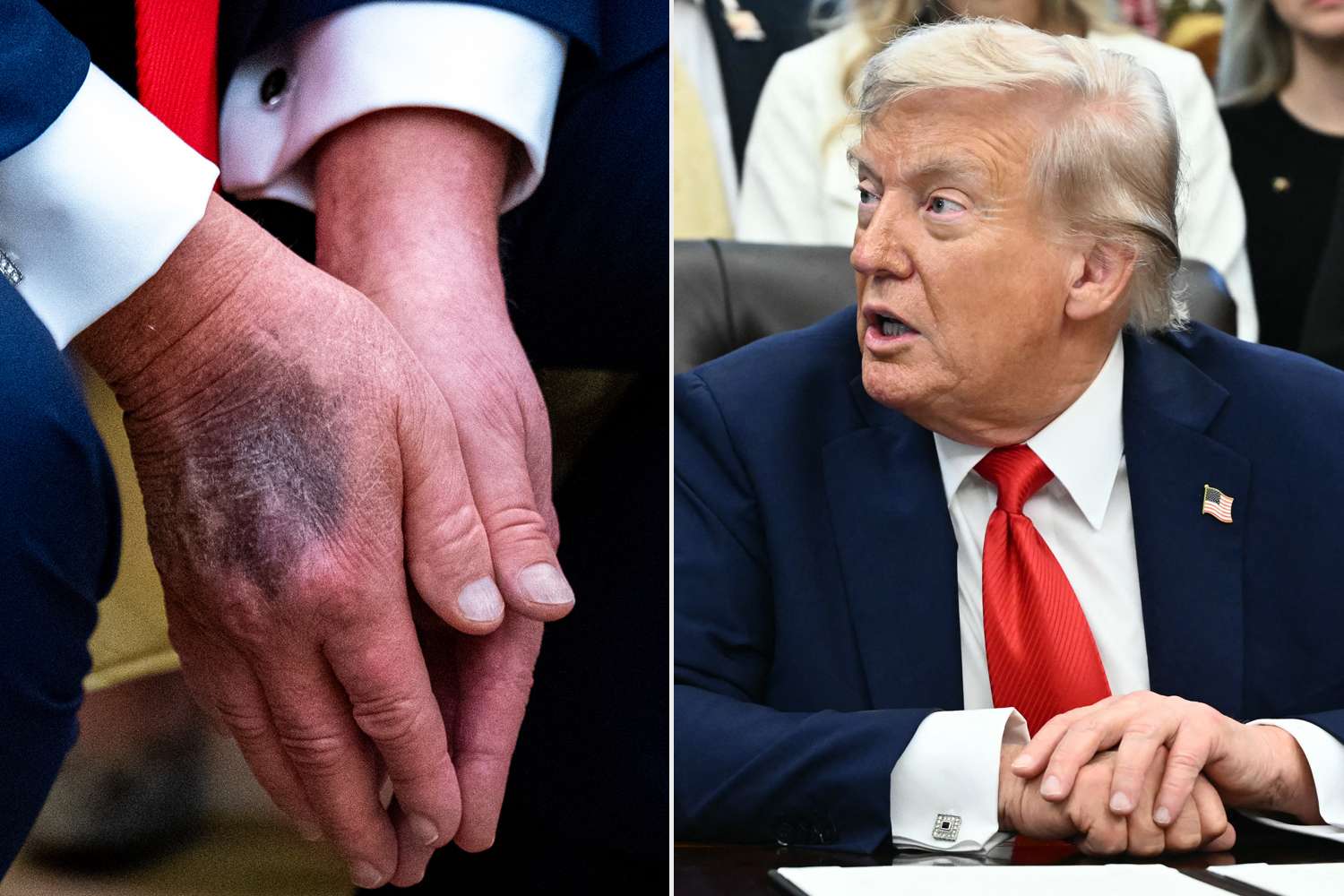 Name:  donald-trump-hand-bruise-1-082625-f31ada4ef7c3486da2352c2b94078644.jpg
Views: 130
Size:  123.5 KB