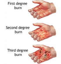 Name:  burn-injury-2.jpg
Views: 477
Size:  16.6 KB